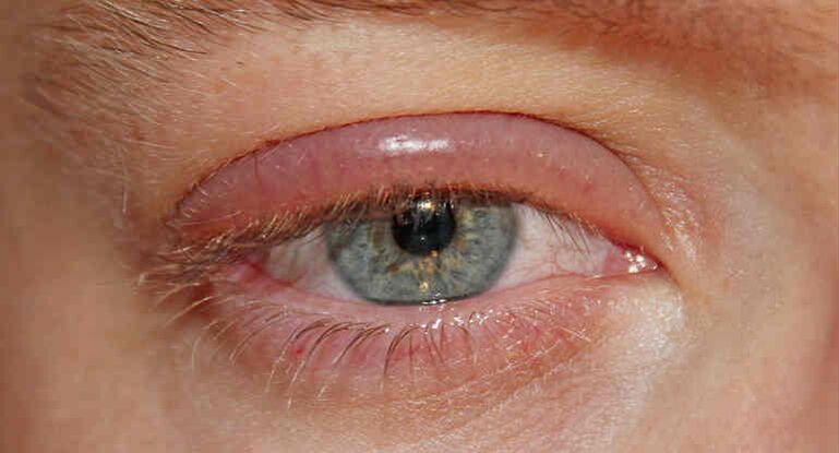 Demodecosis on the eyelids